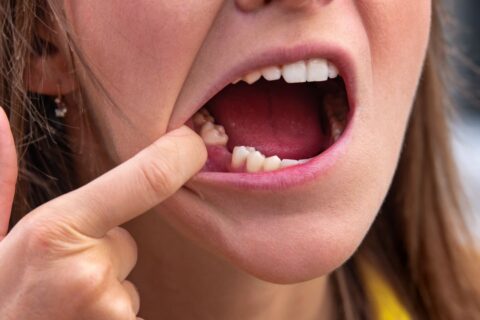 sonhar com dente caindo